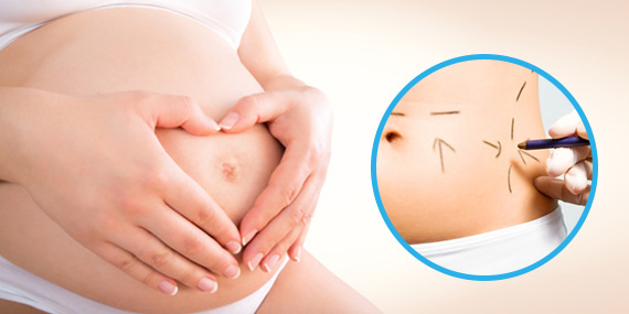 Břicho po porodu trápí ženy více než změny prsou, říká odborník